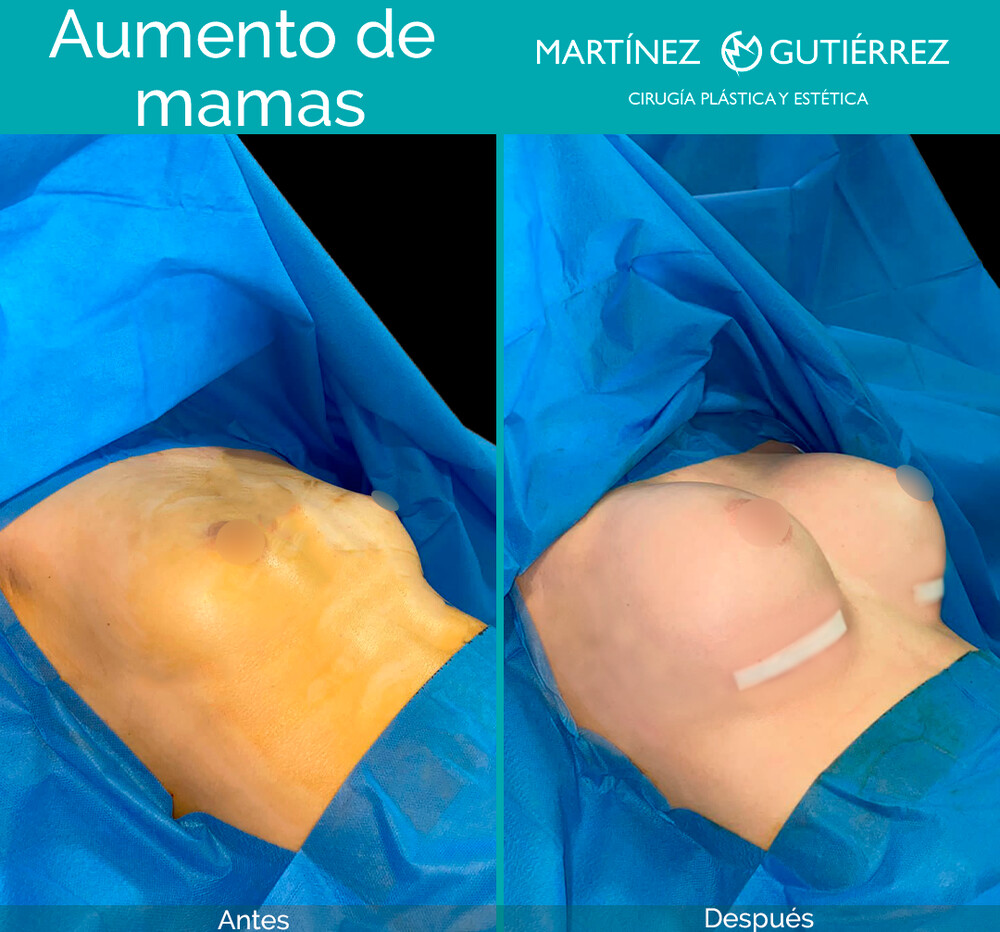 Before and After Result